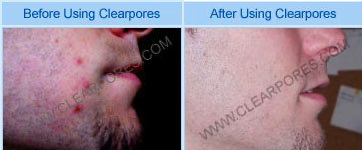 ClearPores System (Recenzie) – Cel Mai Bun Tratament Natural Pentru Acnee?