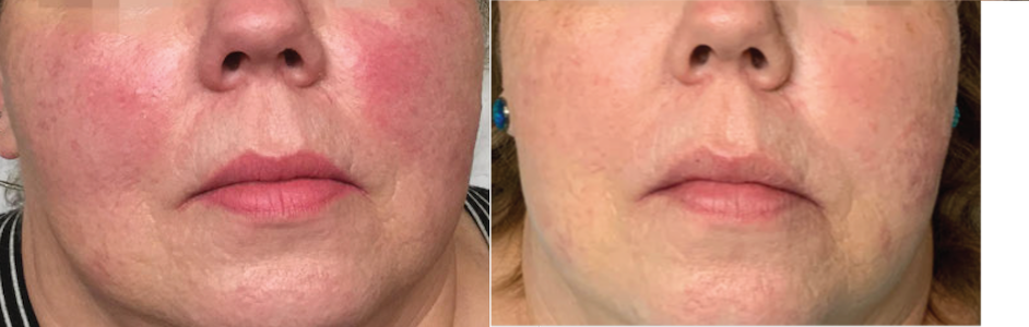 rosacea