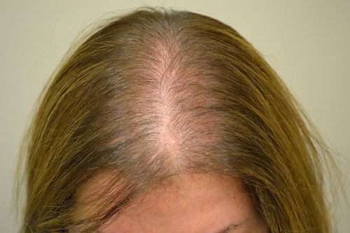 alopecia androgenica femei