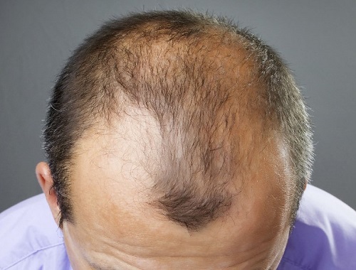 alopecie androgenică